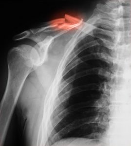 broken bone from animal attack
