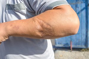 physical dog bite damage