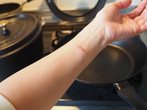 cooking burn
