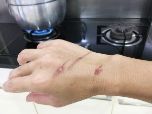 burn injuries from cooking