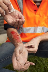 construction site burn injury